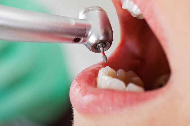 Best Emergency Wisdom Teeth Removal in Rowlett, TX